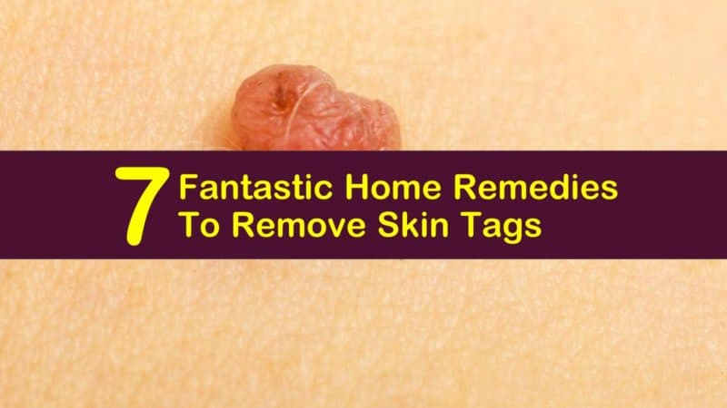 How To Safely Remove Skin Tags With Home Remedies